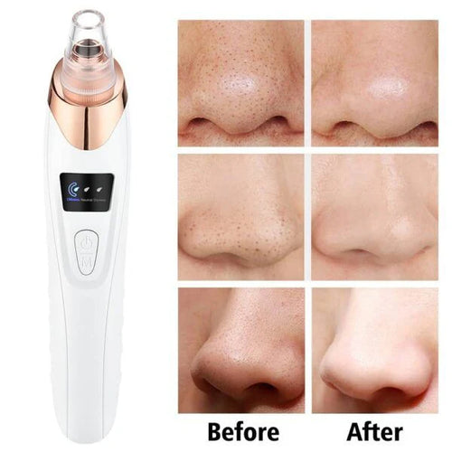 5 in 1 Blackhead remover